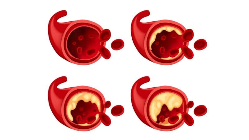 Bệnh mỡ máu là gì và biểu hiện ra sao?