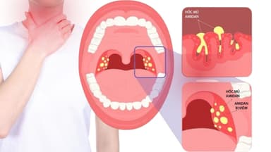 Bị viêm amidan – Dấu hiệu và những lưu ý cần thiết