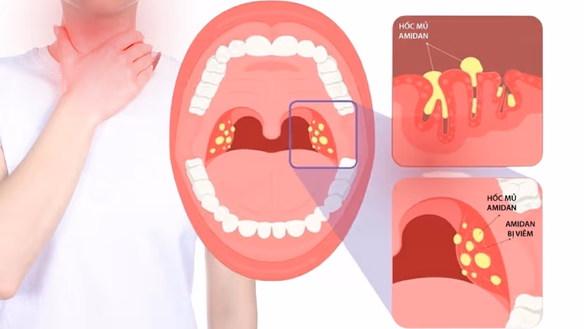 Bị viêm amidan – Dấu hiệu và những lưu ý cần thiết