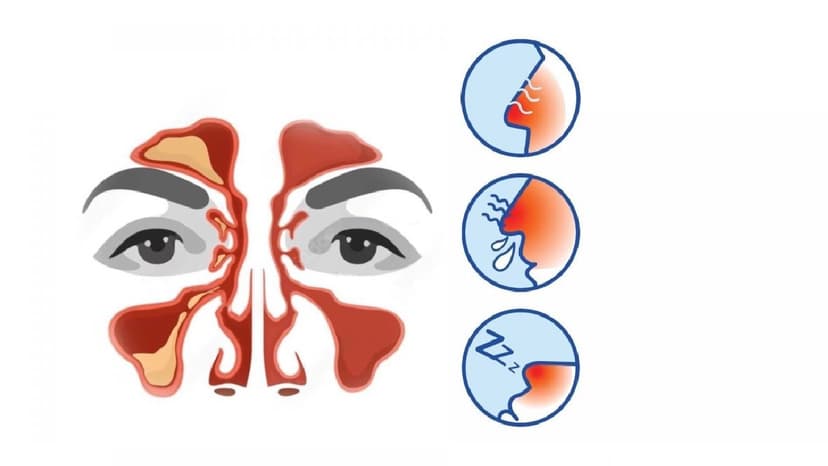 Những dấu hiệu cảnh báo bị viêm xoang và cách điều trị
