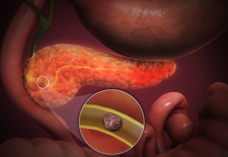 Biến chứng nguy hiểm của sỏi ống mật chủ nếu không được điều trị kịp thời