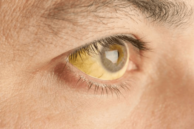 phát hiện sớm ung thư gan và phương pháp chẩn đoán