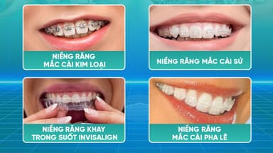 Tìm hiểu về các cách niềng răng