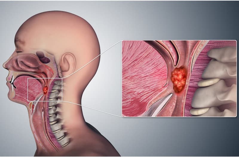 Ung thư vòm họng là một dạng ung thư ác tính xuất hiện ở khu vực vòm họng