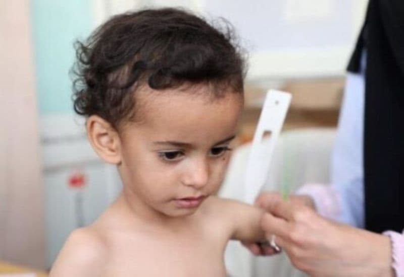 Chăm sóc trẻ suy dinh dưỡng đúng cách rất quan trọng.