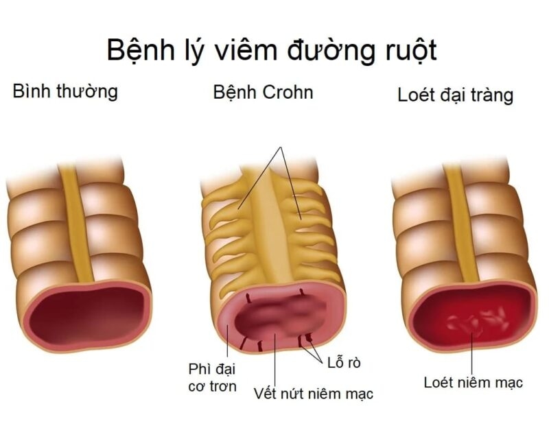 Crohn là một bệnh lý tiêu hóa thuộc nhóm bệnh viêm ruột