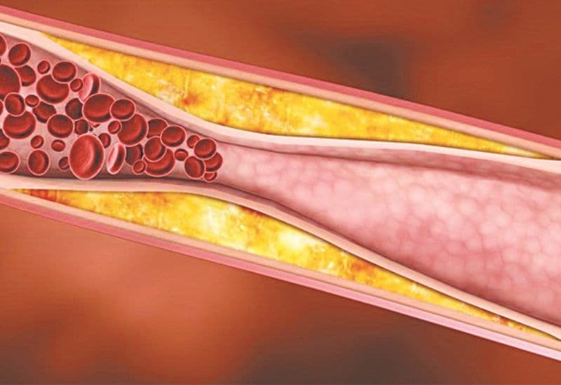 Chế độ ăn của người bị mỡ máu nên đảm bảo tính khoa học và cân đối.