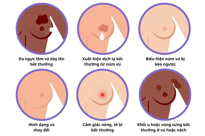 chữa ung thư vú và các dấu hiệu