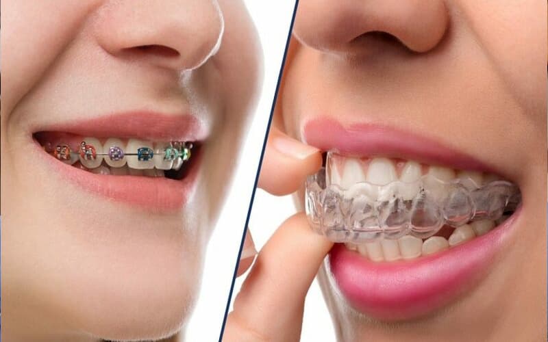 Trẻ Có nên niềng răng không