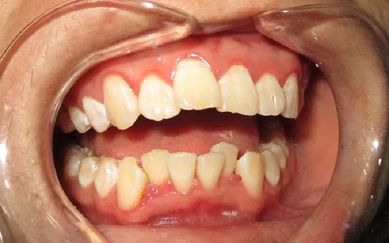 Có nên niềng răng không tại bệnh viện