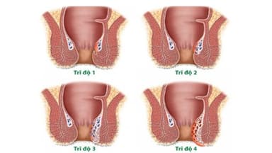 Dấu hiệu trĩ nội độ 2: Nhận biết sớm và cách xử lý hiệu quả