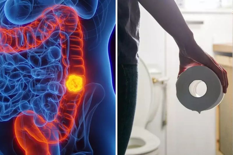 thói quen đại tiện thay đổi khi mắc u đại tràng