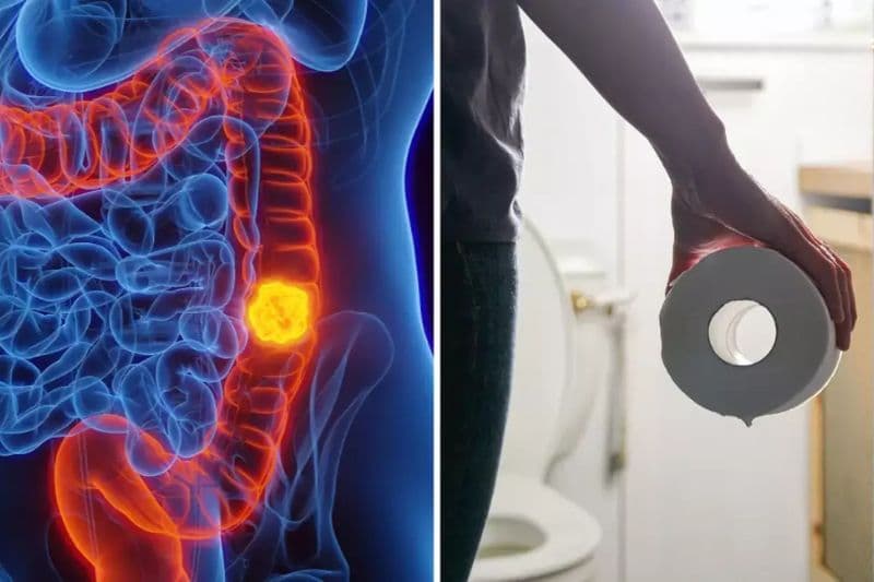 thói quen đại tiện thay đổi khi mắc u đại tràng