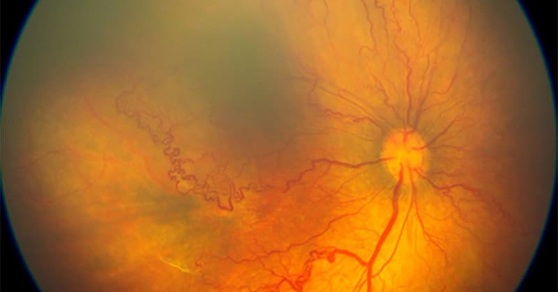 Bong võng mạc là tình trạng võng mạc – lớp mô nhạy cảm với ánh sáng nằm ở phía sau nhãn cầu – bị tách khỏi các lớp mô hỗ trợ bên dưới.