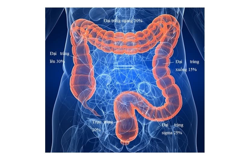 Ung thư đại tràng (còn gọi là ung thư ruột già) là một trong những loại ung thư phổ biến ở cả nam giới và nữ giới