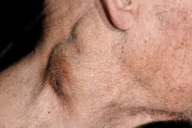 giải đáp ung thư hạch di căn sống được bao lâu