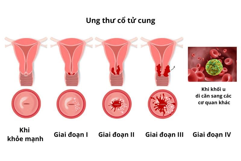 ung thư cổ tử cung và giai đoạn nguy hiểm