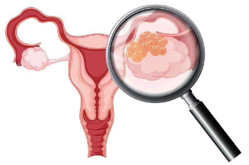 hiểu lầm về ung thư buồng trứng