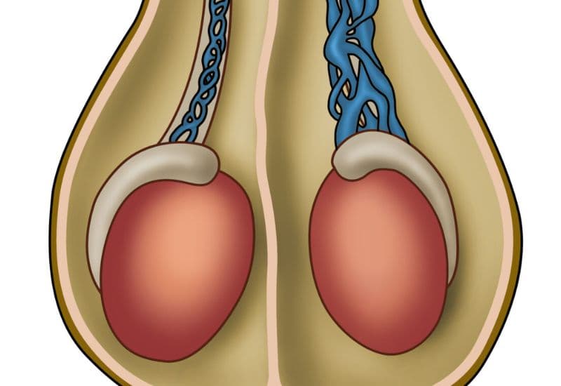 Bị giãn tĩnh mạch tinh có gây vô sinh? Giải đáp từ chuyên gia