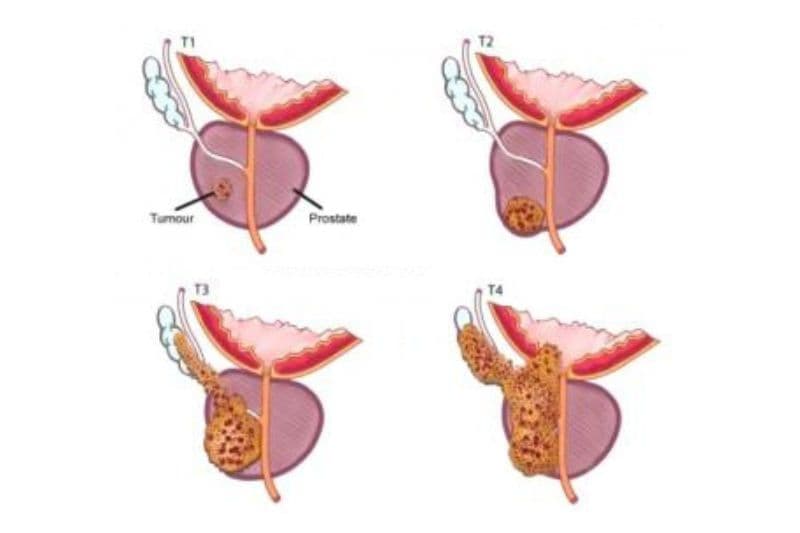 phát hiện ung thư ở giai đoạn sớm nhất.