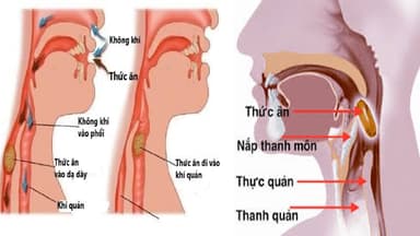 Hóc dị vật đường thở – Những sai lầm điển hình khi sơ cứu