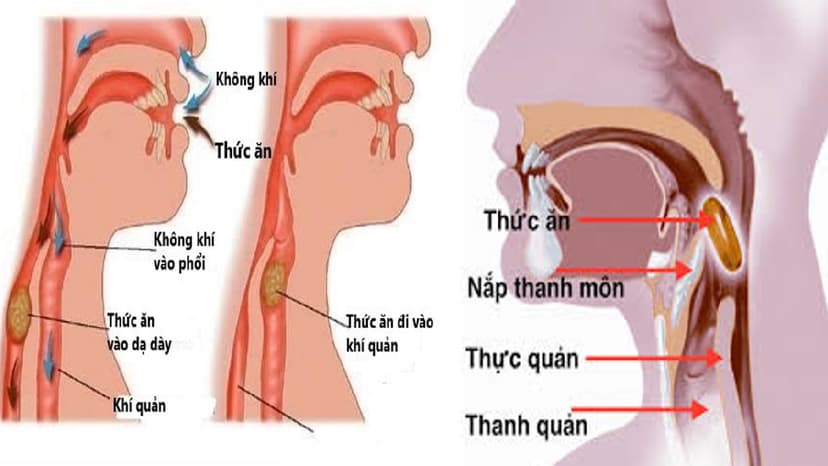 Hóc dị vật đường thở – Những sai lầm điển hình khi sơ cứu