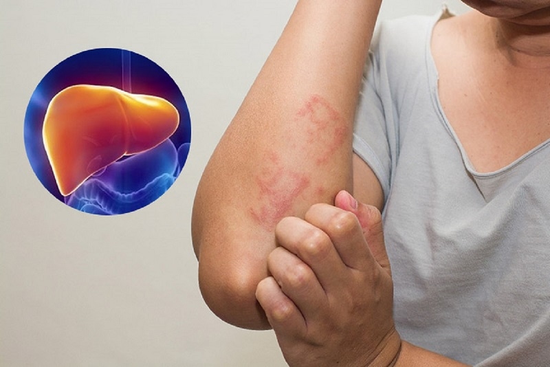 Khi khối u phát triển lớn, nó có thể gây chèn ép ống mật hoặc xâm lấn vào mô gan lành, khiến khả năng lọc thải độc tố và tổng hợp protein của gan bị suy giảm rõ rệt.