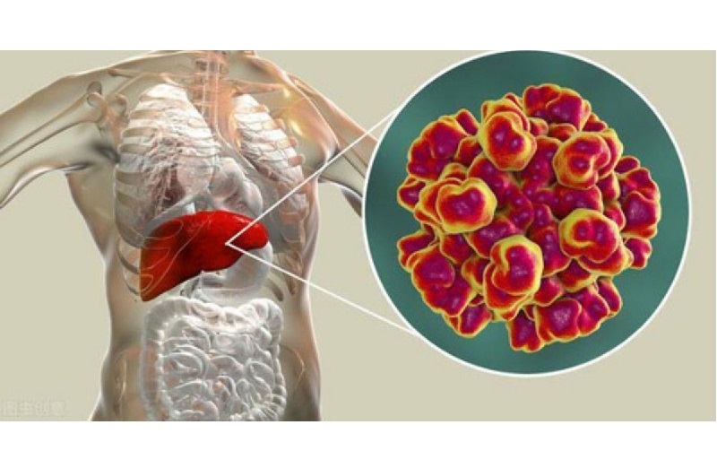 Hội chứng gan - thận là biến chứng ung thư gan