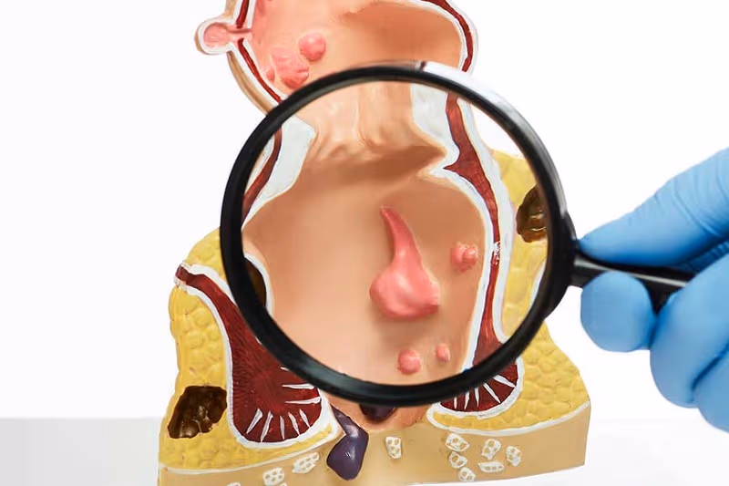 dấu hiệu hạch cứng ở hậu môn