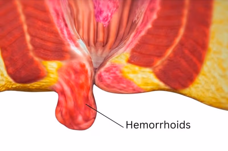 trĩ ngoại cũng có biểu hiện nổi cục cứng
