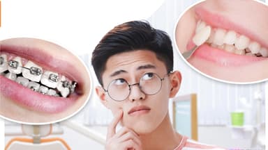 Nên niềng răng hay bọc sứ – Phân tích để lựa chọn