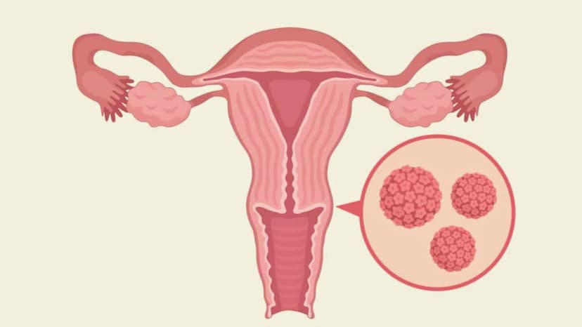 Nguy cơ bị ung thư cổ tử cung nếu mắc HPV: Những điều cần biết