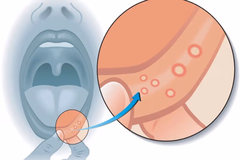 dấu hiệu nổi cục trong miệng không đau