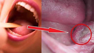 Nguyên nhân quen thuộc dẫn đến ung thư hàm miệng