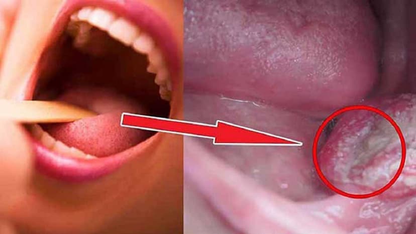 Nguyên nhân quen thuộc dẫn đến ung thư hàm miệng