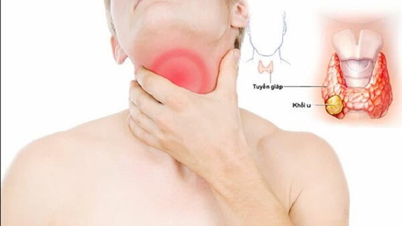 Nhận biết 8 dấu hiệu của bệnh ung thư tuyến giáp giai đoạn cuối