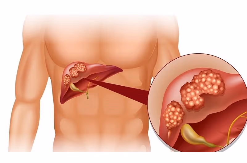 Ung thư đầu tụy