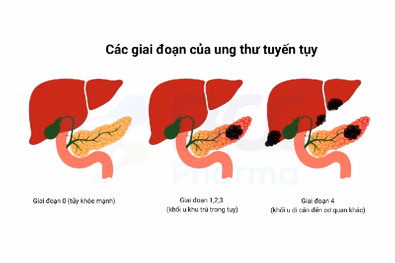 Phần lớn các trường hợp u đầu tụy được phát hiện đều là u ác tính