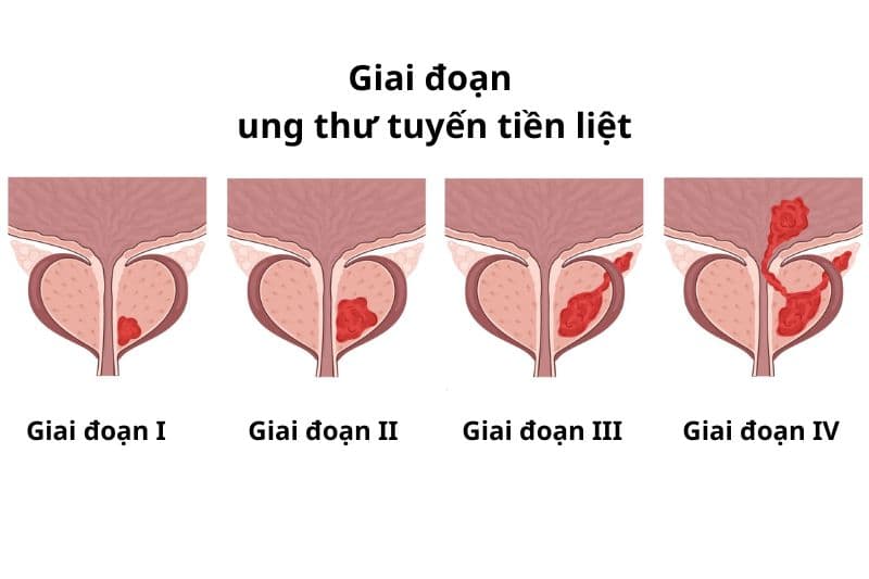 ung thư tuyến tiền liệt giai đoạn 3