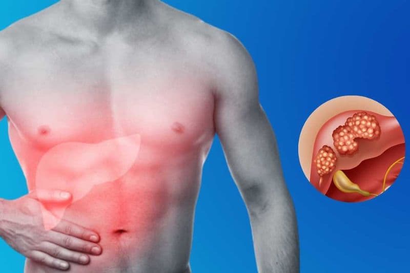 bệnh nhân ung thư gan giai đoạn 3