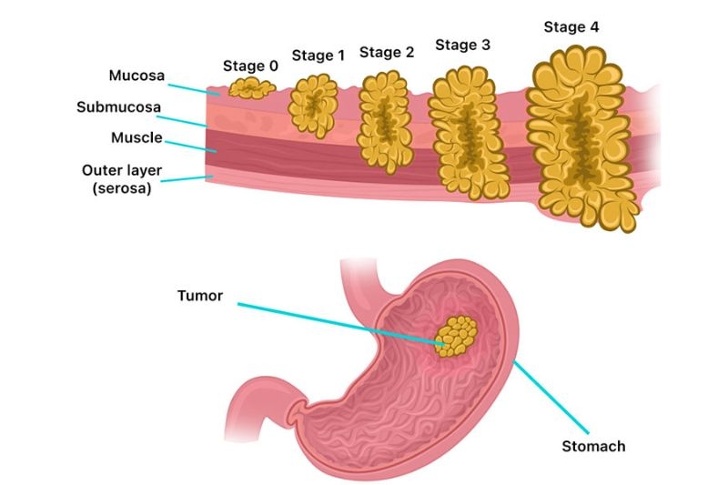 bệnh ung thư dạ dày giai đoạn II
