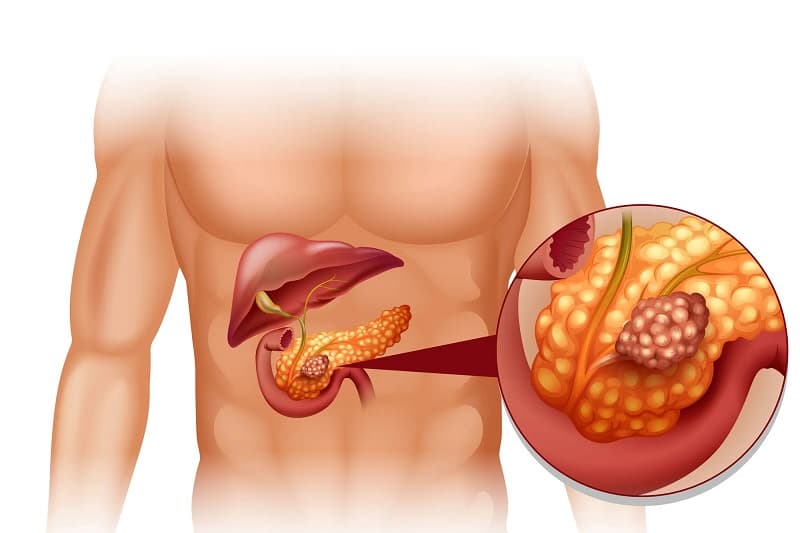 nguyên nhân ung thư tuyến tụy