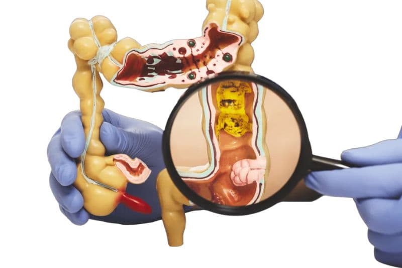 ung thư trực tràng và yếu tố gia đình