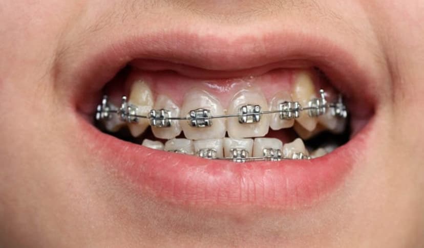 Lợi ích khi niềng răng khểnh và cách chăm sóc sau chỉnh nha