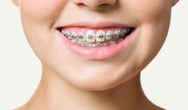 Niềng răng mắc cài là gì? Ưu nhược điểm và lưu ý quan trọng