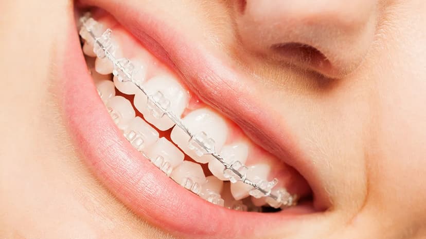 Niềng răng mắc cài sứ và những điều cần biết trước khi lựa chọn