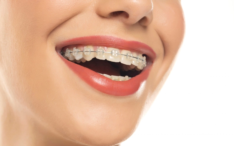 Niềng răng mất bao lâu thời gian