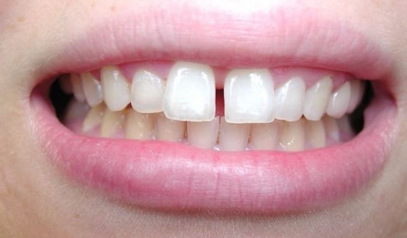 Chăm sóc và niềng răng thưa đúng cách để có hàm răng hoàn hảo