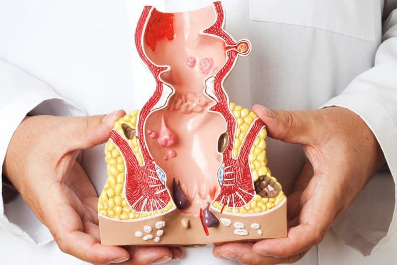 ung thư hậu môn và nguy cơ