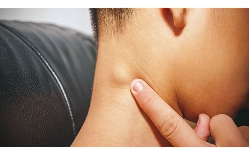 Có 3 dạng di căn thường gặp ở ung thư hạch bạch huyết